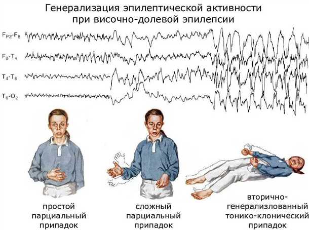 Основные типы эпилепсии: причины, симптомы и лечение.