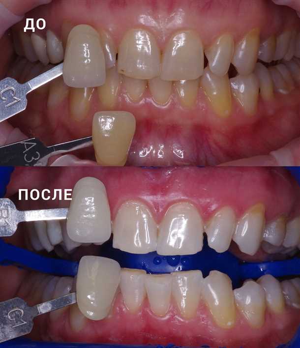 Отбеливание зубов какой способ лучше