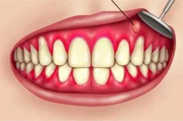 Пиорея и отек десны