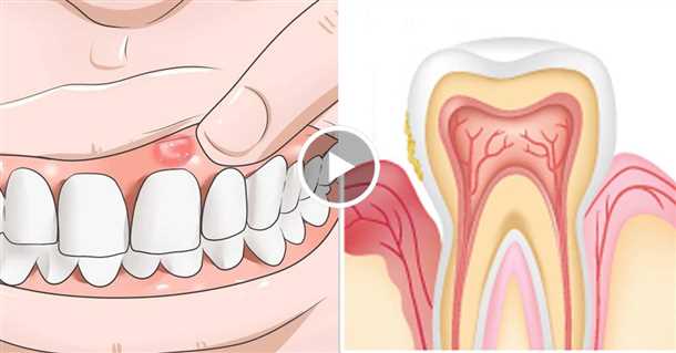 Симптомы пародонтита