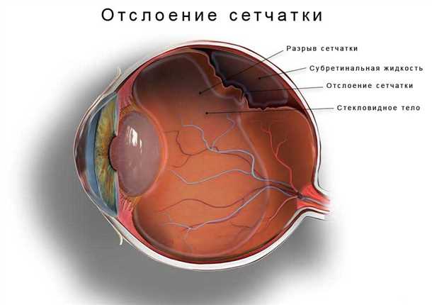 Понятие отслойки сетчатки. Что это значит?