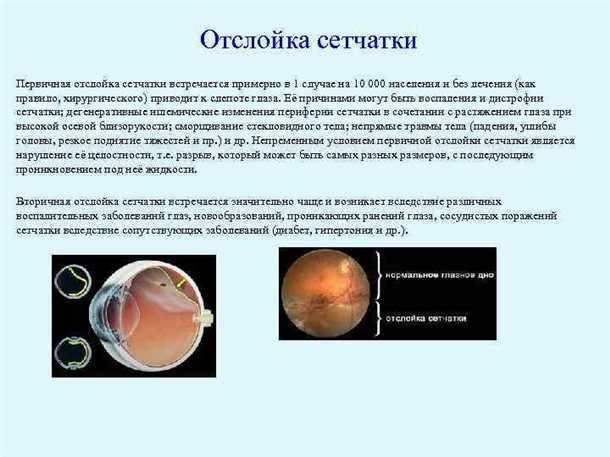 Причины отслойки сетчатки