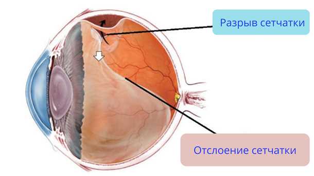 Причины и симптомы отслойки сетчатки. Как проходит лечение?
