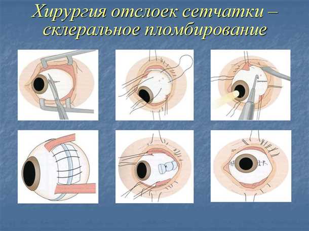 Отслойка сетчатки, лечение причины и симптомы. Все о глазных болезнях - vseozrenii.