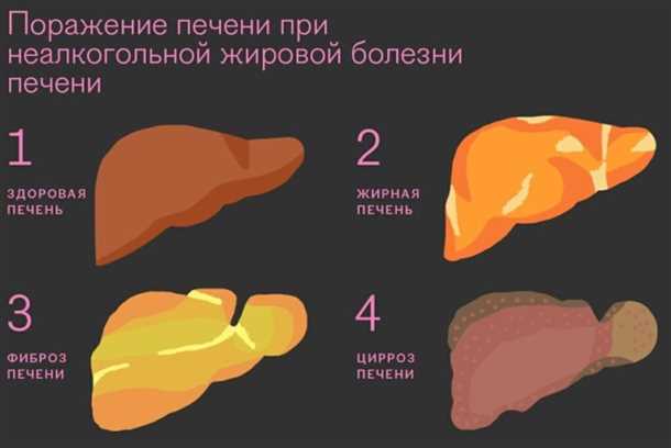  Причины и факторы риска развития ожирения печени 