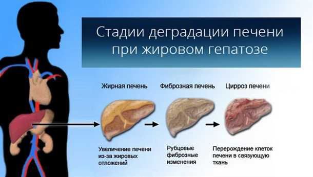 Ожирение печени