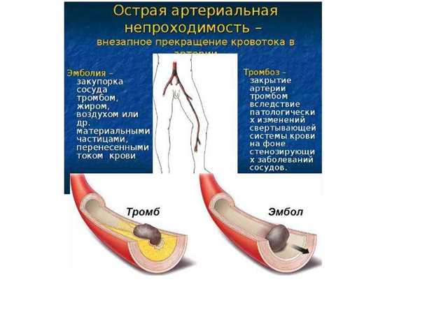 Патология периферических сосудов: атеросклероз, тромбозы, эмболии.