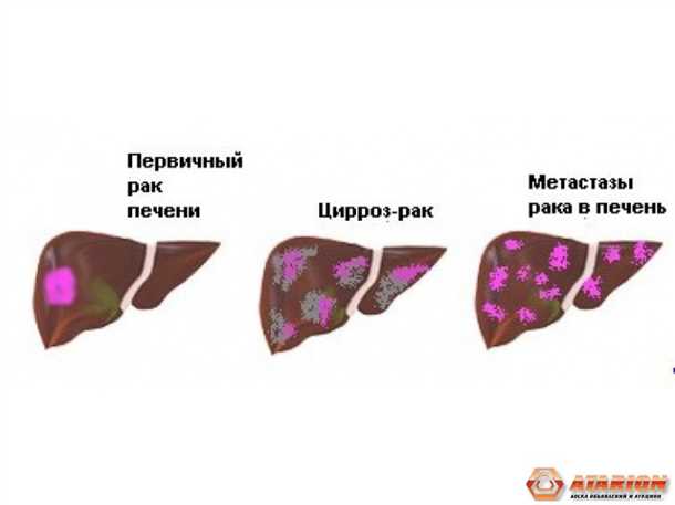 Гепатобластома
