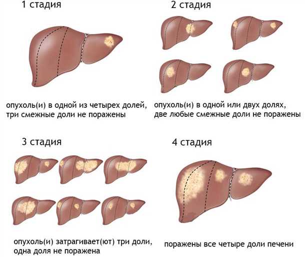 Причины возникновения печеночной опухоли