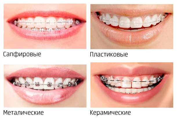 Пластиковые брекеты
