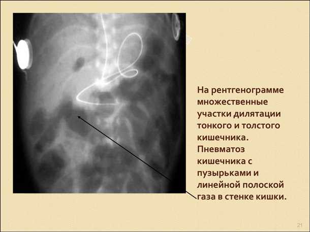 Пневматоз кишечника: возможность хирургического вмешательства