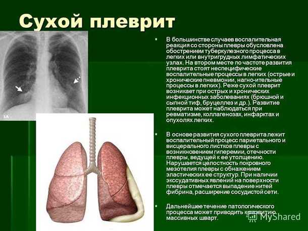 Плевриты и нейрологические симптомы