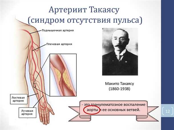 Поражение сосудов при системных заболеваниях: артерииты, васкулиты.