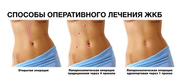 1. Желчный приступ после удаления желчного пузыря