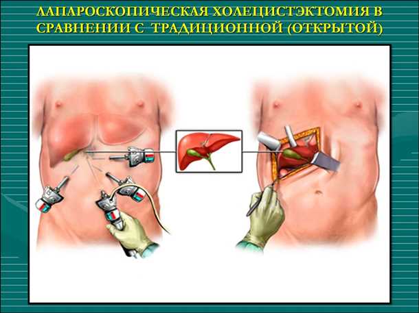 После операции по удалению желчного пузыря