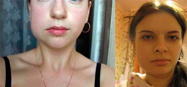 После удаления зуба опухла щека