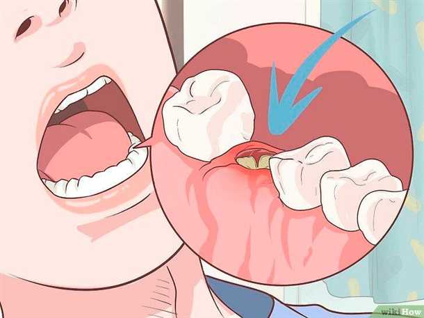 Возможные причины побеления десен после удаления зуба