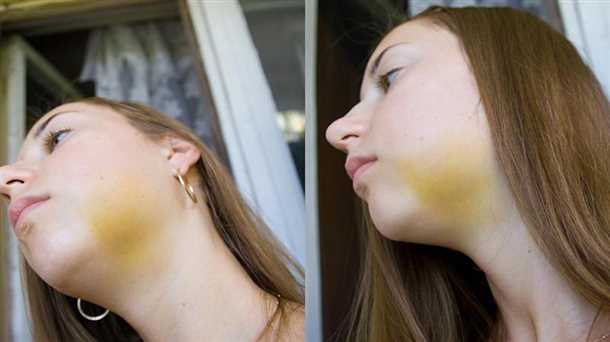 Побеление десны после удаления зуба После удаления зуба побелела десна