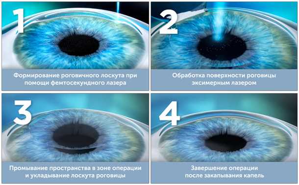 Плюсы лазерной коррекции зрения: