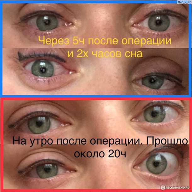 Последствия лазерной коррекции зрения, отзывы