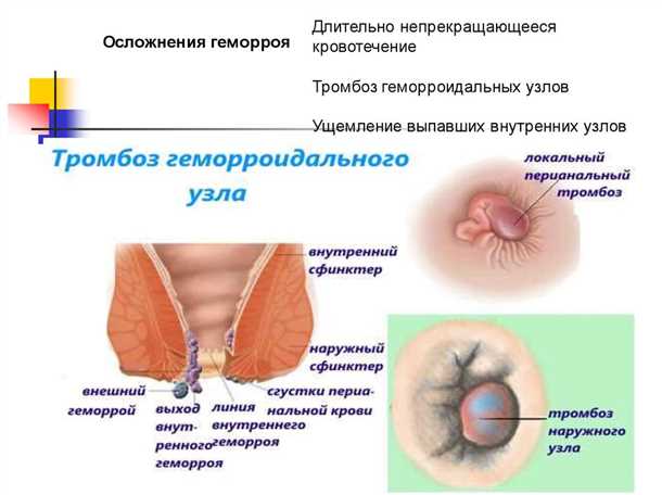 Кровотечение из прямой кишки