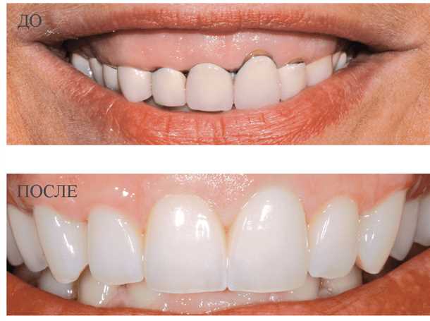 Протезирование зубов десна