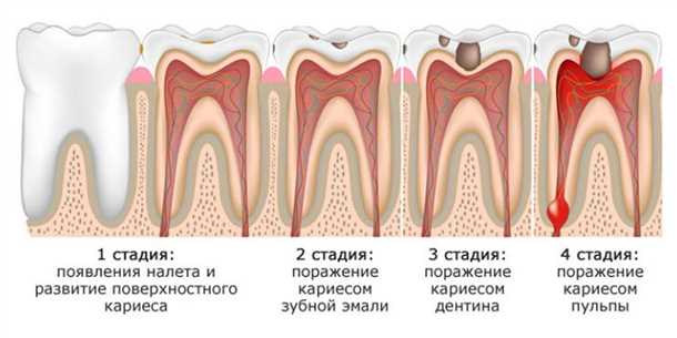 Причины пульсирующей боли в зубе у детей