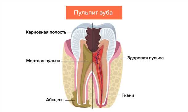 Пульсирующая боль в зубе у детей: особенности и лечение