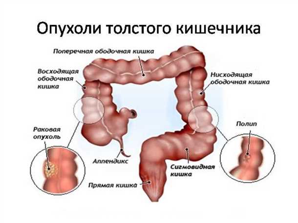 Рак кишечника: симптомы, лечение и прогноз для жизни