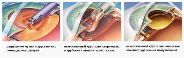 Глазные капли