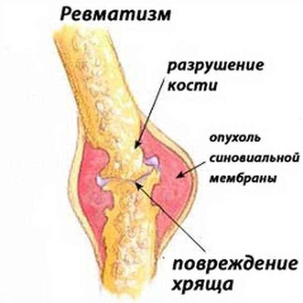 Следствия ревматизма: последствия и проблемы