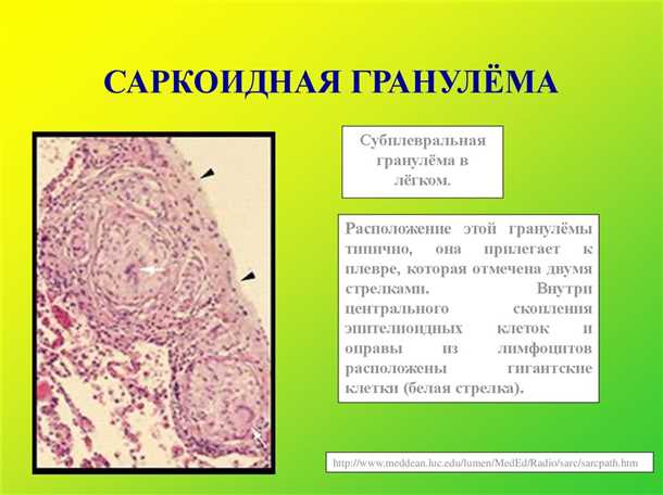 Диагностика саркоидоза ЦНС: методы и трудности