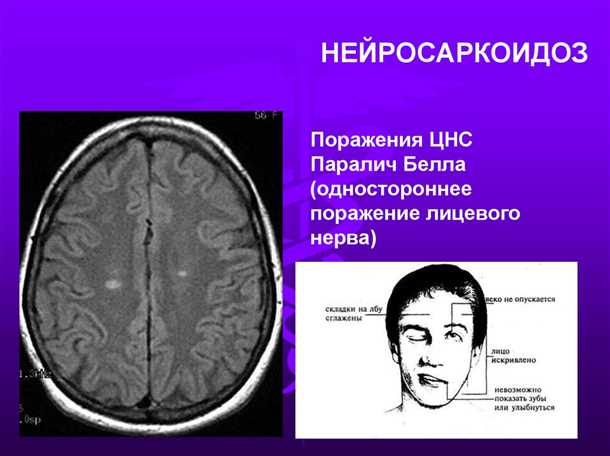 Саркоидоз центральной нервной системы.