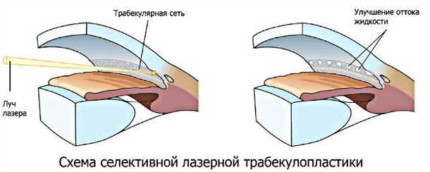 Что такое селективная лазерная трабекулопластика?