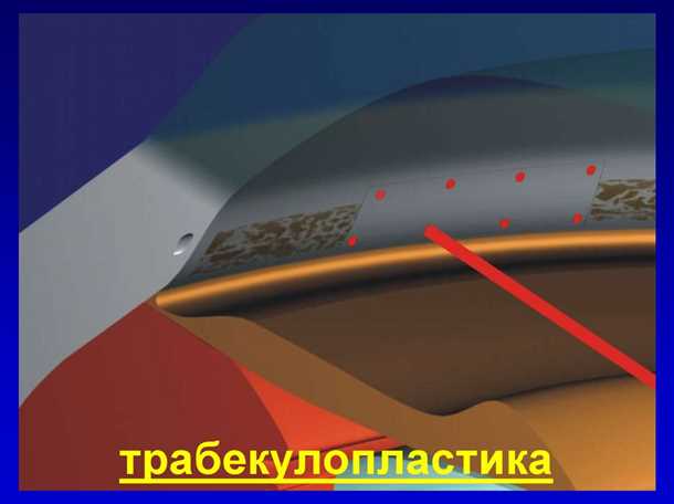 Кого рекомендуется проходить селективную лазерную трабекулопластику?