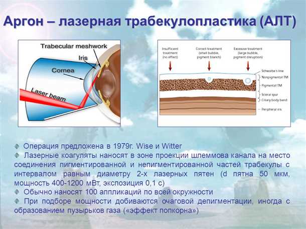 Селективная лазерная трабекулопластика - новое слово в лечении глаукомы с помощью лазерного воздействия на трабекулярный сетчатый слой Селективная лазерная трабекулопластика