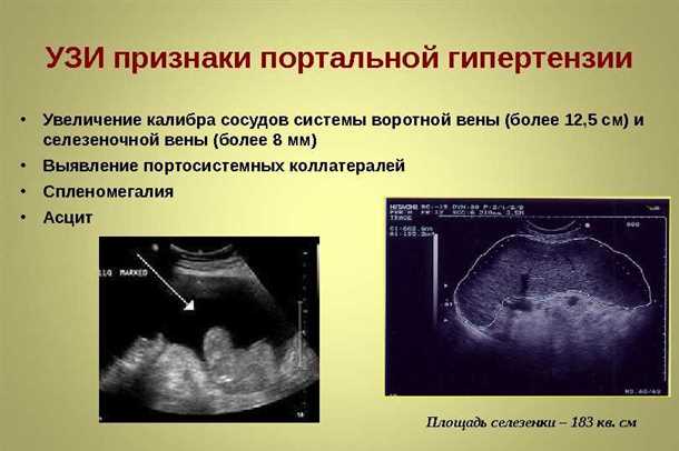 Селезеночная вена норма: основные аспекты