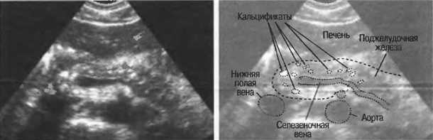 Лечение и профилактика заболеваний селезеночной вены