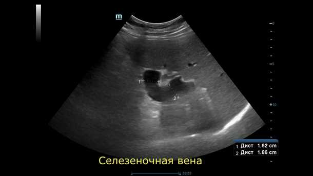 Основные методы диагностики состояния селезеночной вены