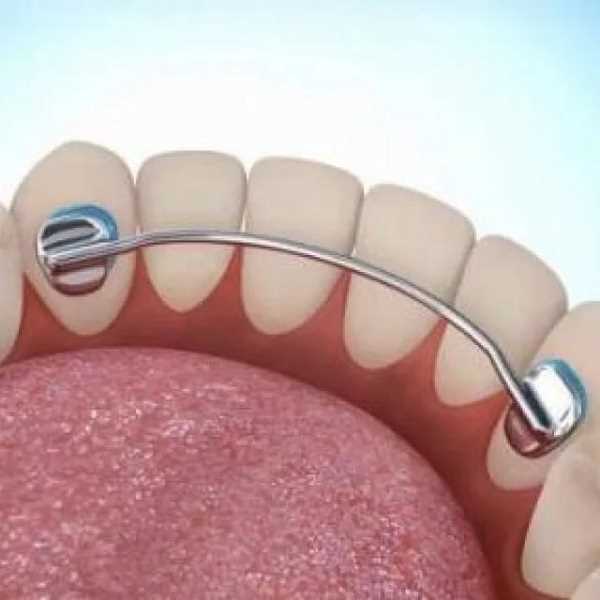 Преимущества шинирования зубов