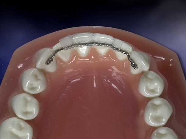 Визуальный эффект шинирования зубов