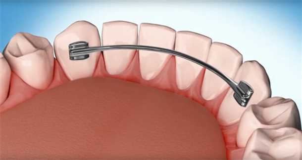 Как происходит процедура шинирования зубов?