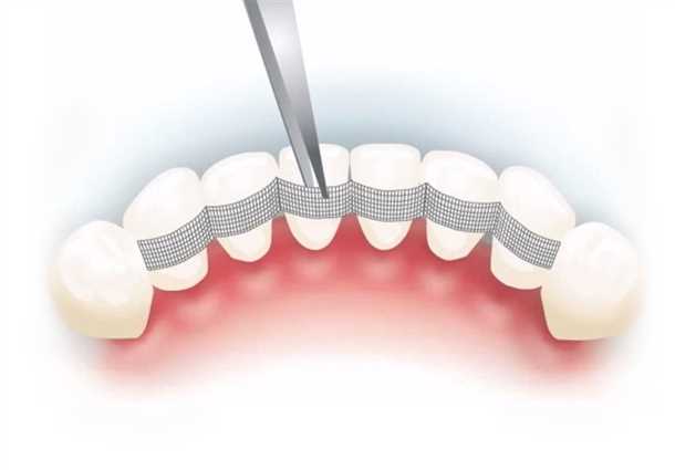 Что такое шинирование зубов?