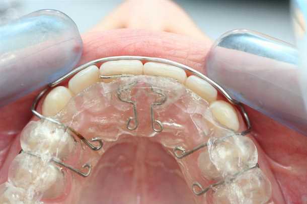 Шинирование зубов после брекетов Шинирование зубов после брекетов
