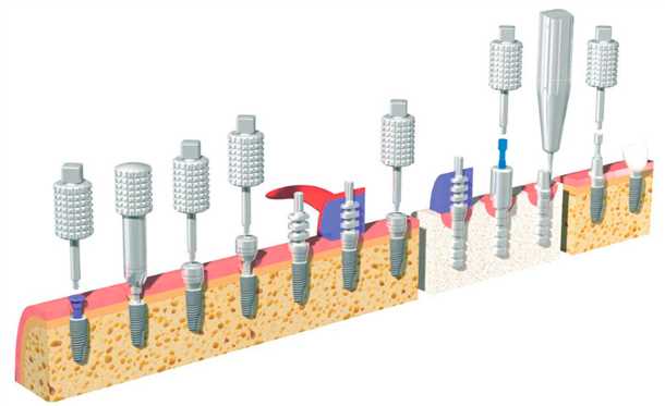 Швейцарские импланты - инновационные решения для лечения патологий
