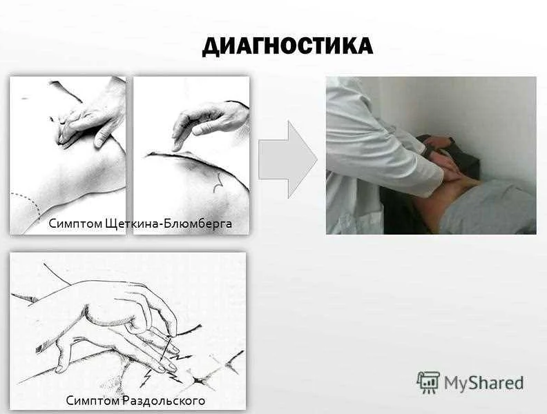 Значение симптома Щёткина-Блюмберга в медицинской практике