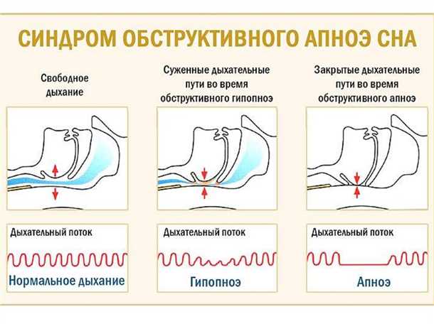 Таблица: Влияние синдрома прерывания дыхания во время сна на организм