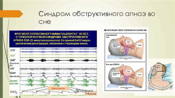 Синдром обструктивного апноэ во сне