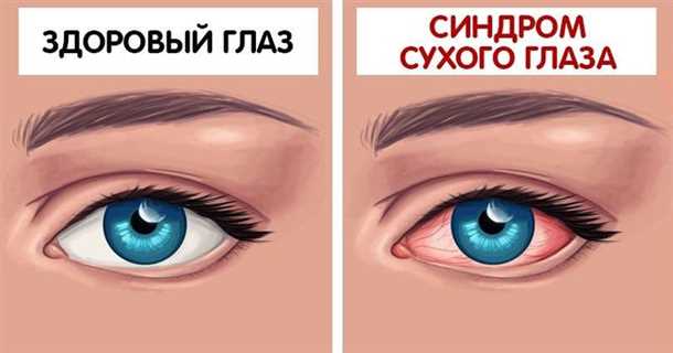 Синдром «сухого глаза» симптомы, причины, лечение. Все про глазные болезни - vseozrenii.