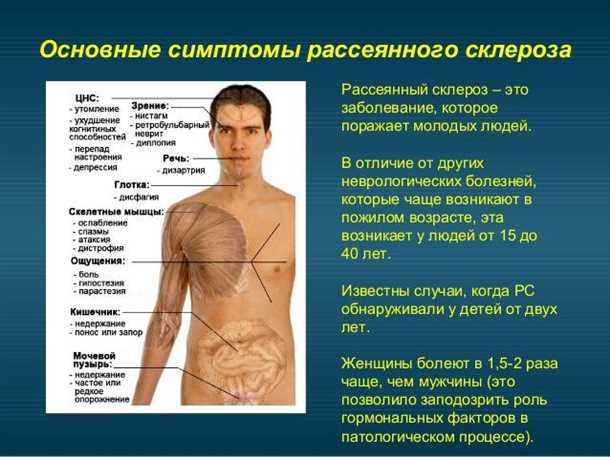 Склероз множественный